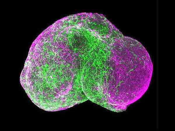 lösemi-diyabet-kök_hücre-alzheimer-demans